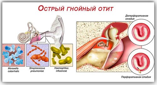 lechenieotitauvzroslixvdomashnixusloviya 2E5BEB69 - Лечение отита в домашних условиях – 5 эффективных средств