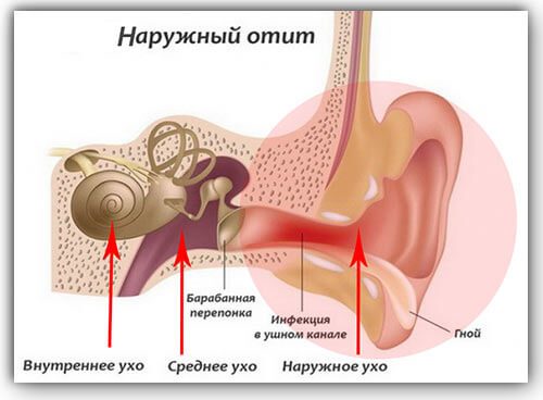 lechenieotitauvzroslixvdomashnixusloviya 480E7CF4 - Как лечить воспаление уха в домашних условиях: народные методы и медикаментозные препараты при отите