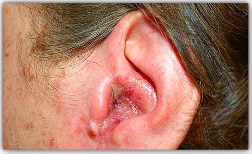 lechenieotitauvzroslixvdomashnixusloviya 56C31B88 - Как лечить воспаление уха в домашних условиях: народные методы и медикаментозные препараты при отите