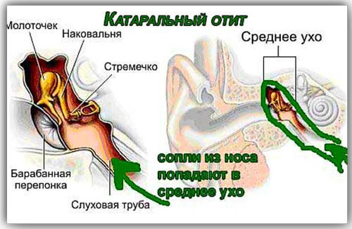 lechenieotitauvzroslixvdomashnixusloviya 7E45EB45 - Отит: лечение в домашних условиях