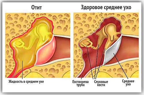 lechenieotitauvzroslixvdomashnixusloviya 8BBFAF54 - Отит: лечение в домашних условиях