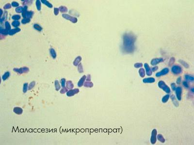 malasseziyausobaksimptomidiagnostikalech DC5C527B - Малассезиозный отит