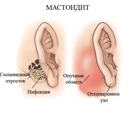 mastoiditprichinisimptomilechenieprofila 86B02A30 - Острый и хронический мастоидит: симптомы и лечение