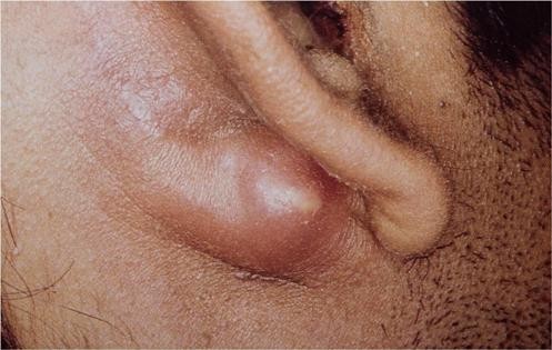 mastoiditprichinisimptomilechenieprofila F8FF2C0D - Острый и хронический мастоидит: симптомы и лечение