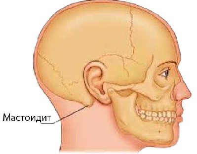 mastoiditxarakteristikasimptomilecheniep E7415B1A - Воспалился лимфоузел за ухом: что это за опухоль, почему он может воспаляться, лечение недуга