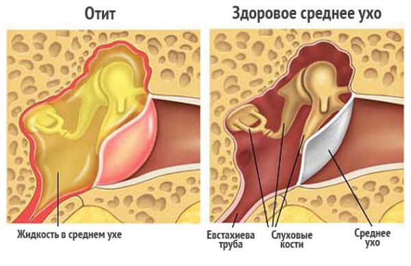 naruzhniydiffuzniyotitsimptomiilechenie CE53A54A - Диффузный отит наружного уха — симптомы и лечение
