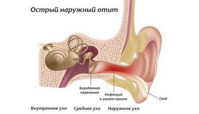 naruzhniyotitfoto D0A2AD6D - Отит среднего уха: симптомы и лечение, фото