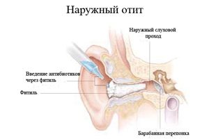 naruzhniyotitotitnaruzhnogouxauvzroslogo E5A1A21E - Наружный отит (отит наружного уха) у взрослого – причины, симптомы и лечение наружного отита