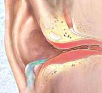 naruzhniyotitprichinisimptomidiagnostika 08EE0030 - Отит острый наружный ограниченный (фурункул уха)