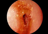 naruzhniyotitprichinisimptomidiagnostika 51557A93 - Отит острый наружный ограниченный (фурункул уха)