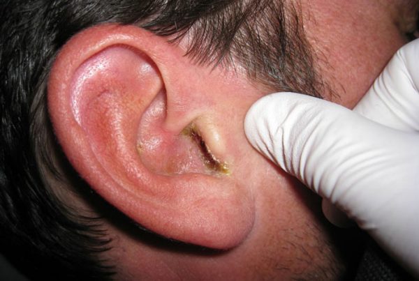 naruzhniyotitsimptomiilechenie A270F433 - Наружный отит (отит наружного уха) у взрослого – причины, симптомы и лечение наружного отита