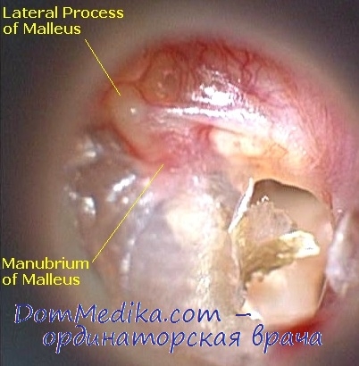 neobxodimostoperatsiiprixronicheskomsred 0C34B2BD - Операция при отите среднего уха