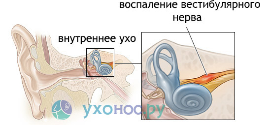 nevritsluxovogonervasimptomiilechenie CB0BD00E - Неврит слухового нерва: симптомы и лечение воспаления