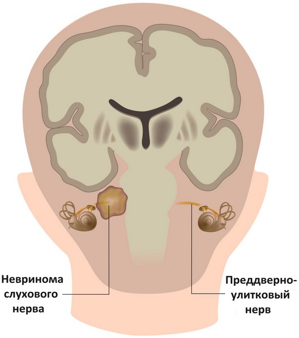 nevritsluxovogonervasimptomilechenieipri C72A83F7 - Неврит слухового нерва: симптомы и лечение воспаления