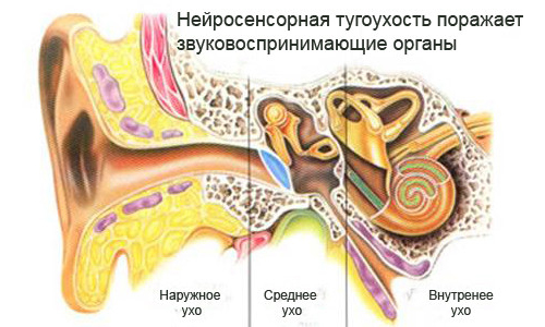 neyrosensornayatugouxostkodpomkb10123ste FDA13105 - Нейросенсорная тугоухость: лечение, симптомы, степени и причины