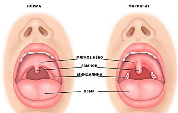 odnostoronnyayabolvgorlepriglotaniiprich 5B72EAD1 - Односторонняя боль в горле при глотании: причины и лечение