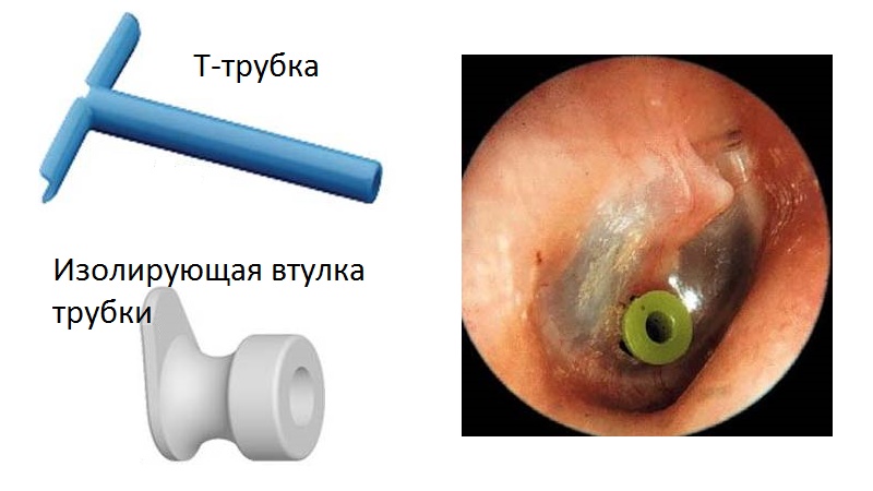 operatsiyanauxopriotitevkakixsluchayaxde 79AC8A4D - Операция на ухо при хроническом гнойном отите