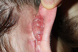 oslozhneniyaiposledstviyaotitauvzroslixc 4549E56F - Осложнения отита: последствия и восстановление слуха