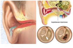 oslozhneniyanaushiposlegrippa 687666E7 - Осложнения на уши у взрослых после отита, гриппа или простуды: что делать, как лечить