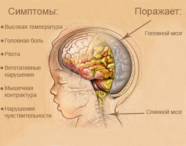 oslozhneniyaposlegnoynogootitaudeteyivzr 6F08B1D4 - Осложнения отита: последствия и восстановление слуха