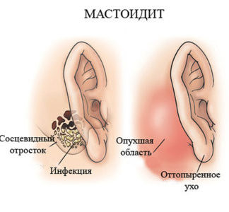 oslozhneniyaposlesrednegootitaudeteyivzr 12B170B7 - Осложнения отита: последствия и восстановление слуха