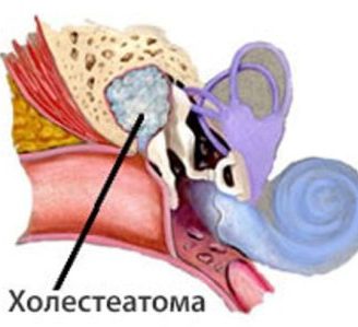 oslozhneniyaposlesrednegootitaudeteyivzr 2C000601 - Осложнения отита: последствия и восстановление слуха