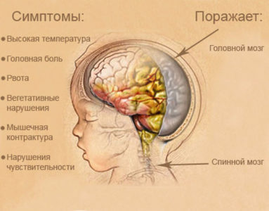 oslozhneniyaposlesrednegootitaudeteyivzr 85830DAE - Осложнения отита: последствия и восстановление слуха