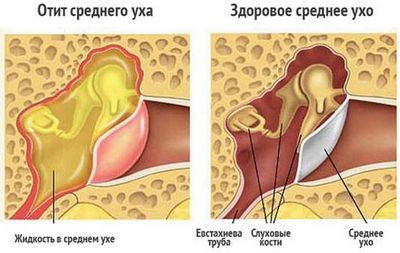 ostrayagolovnayabolpriotite 2126880F - Отит голова болит ребенка, Боли у ребенка