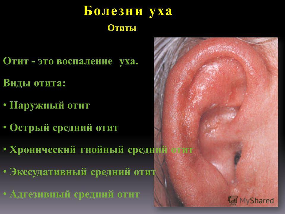 ostriygnoyniysredniyotitfoto 87B21D33 - Гнойный отит: причины, симптомы, лечение, фото