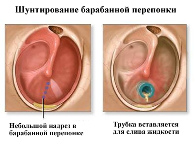 ostriyixronicheskiygnoyniyotitsrednegoux 10BCF3E1 - Хронический гнойный средний отит уха