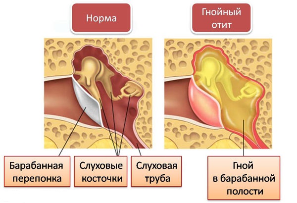 ostriyixronicheskiygnoyniyotitsrednegoux 26E4C9EF - Хронический гнойный средний отит уха