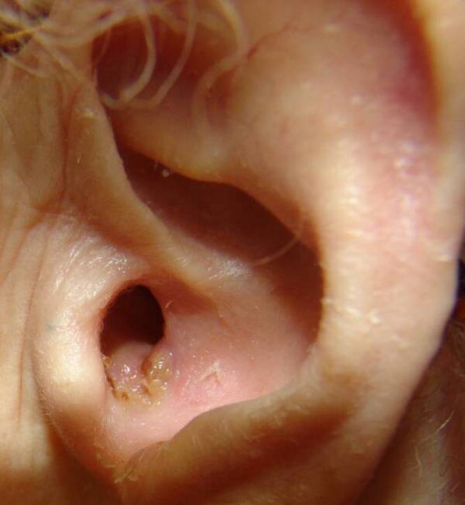 ostriyixronicheskiygnoyniyotituxasimptom 800AD3E3 - Гнойный отит у ребенка (40 фото): симптомы, признаки и лечение острого гнойного отита и среднего уха в домашних условиях у новорожденного