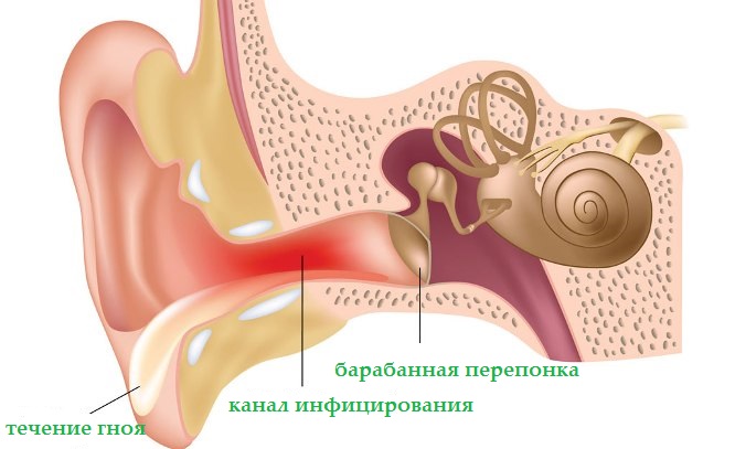 ostriyixronicheskiygnoyniyotituxasimptom B335713A - Гнойный отит у ребенка (40 фото): симптомы, признаки и лечение острого гнойного отита и среднего уха в домашних условиях у новорожденного