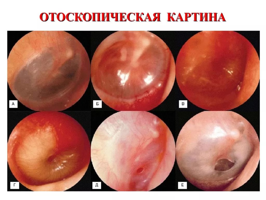 ostriykataralniysredniyotitpodrobnayainf 0346666A - Катаральный отит: симптомы, диагностика и лечение