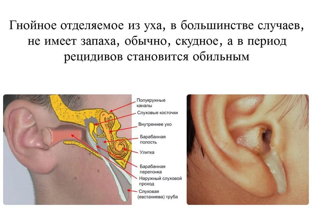 ostriykataralniysredniyotitpodrobnayainf 3A3D3584 - Катаральный отит: симптомы, диагностика и лечение
