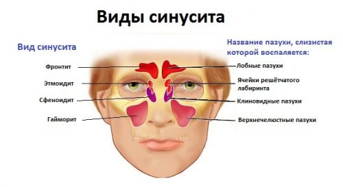 ostriysinusitprichinisimptomiilechenieza 8475DE9A - Острый синусит – инфекционное заболевание околоносовых воздушных полостей — пазух носа