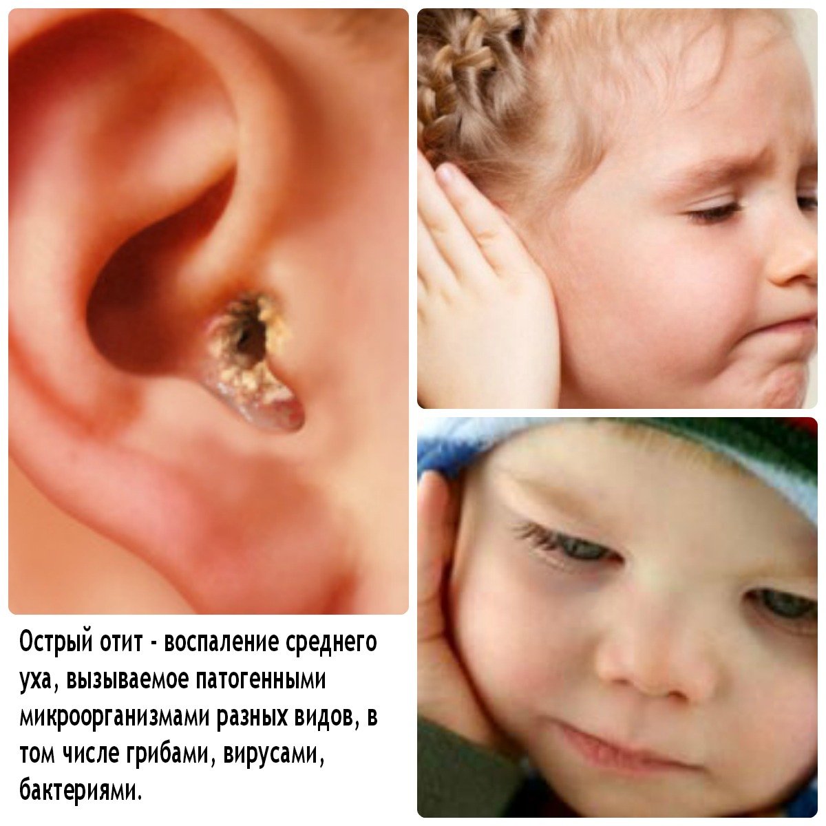 ostriysredniyotitudeteyfoto C2F9716C - Гнойный отит у ребенка: фото, симптомы, чем лечить и последствия