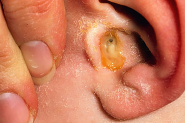 ostriysredniyotituxastadiividisimptomile E7597F2E - Отит среднего уха: симптомы и лечение, фото
