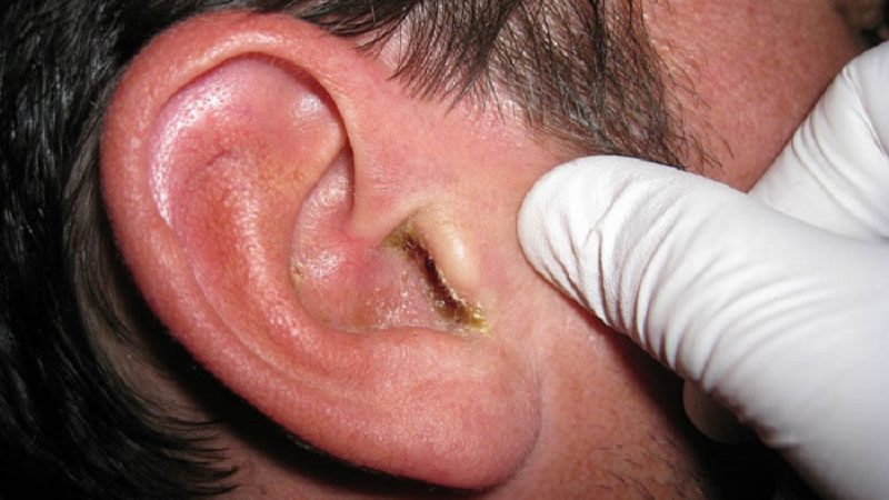 otitkodpomkb10naruzhniyostriysredniy 9E767842 - Корочки в ушах, сухие уши и шелушение ушей: причины и методы избавления