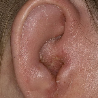otitnaruzhnogouxafotoostrogognoynogoixro 2DCEB20E - Отит среднего уха: симптомы и лечение, фото