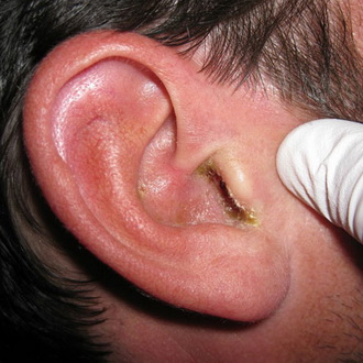 otitnaruzhnogouxafotoostrogognoynogoixro A210C7ED - Отит среднего уха: симптомы и лечение, фото