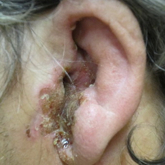 otitnaruzhnogouxafotoostrogognoynogoixro E9189E4A - Отит среднего уха: симптомы и лечение, фото