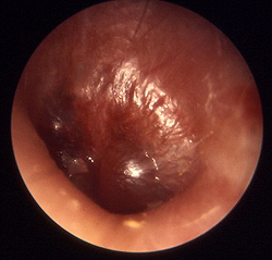 otitprichinisimptomidiagnostikailechenie 8414C716 - Внутренний отит уха: симптомы, лечение