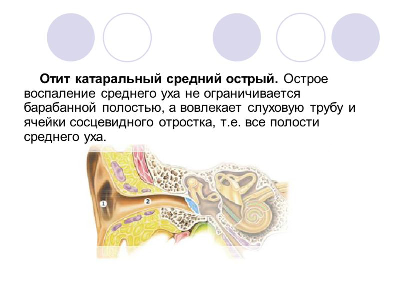 otitsrednegouxalechenieuvzroslixpodrobni 5C86E5BA - Отит у взрослых: симптомы, лечение, капли для отита среднего уха