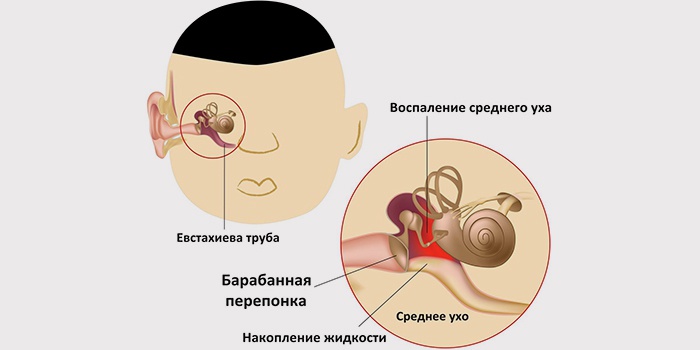 otitsrednegouxasimptomiilechenieekssudat 01B30BEA - Отит у взрослых: симптомы, лечение, капли для отита среднего уха