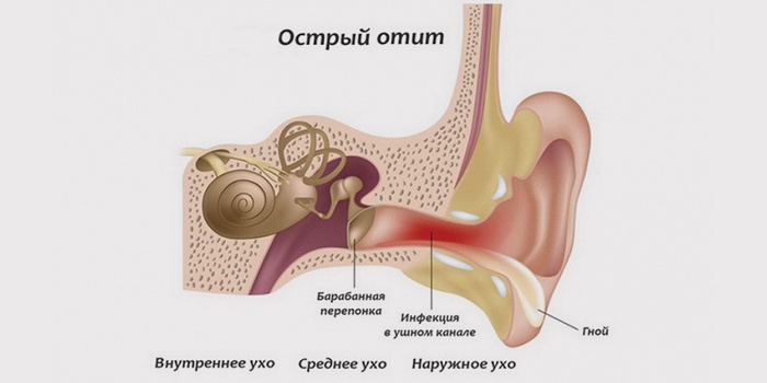 otitsrednegouxasimptomiilechenieekssudat 6A2134EE - Отит у взрослых: симптомы, лечение, капли для отита среднего уха