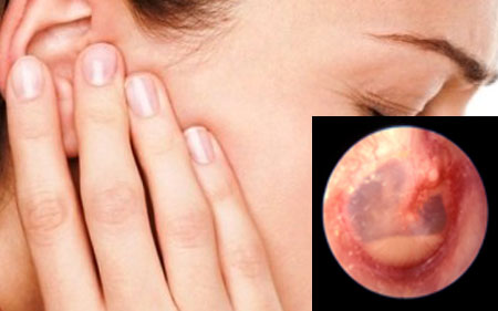otitsrednegouxasimptomiilecheniefoto 2C31F97C - Отит среднего уха: симптомы и лечение, фото