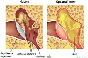 otitsrednegouxasimptomiilechenieuvzrosli D5F284B8 - Отит у взрослых: симптомы, лечение, капли для отита среднего уха