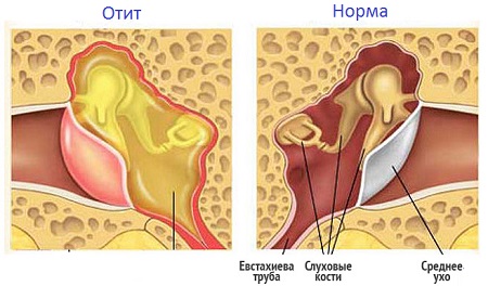 otituvzroslixsimptomilecheniekaplidlyaot EF1B18EE - Отит у взрослых: симптомы, лечение, капли для отита среднего уха