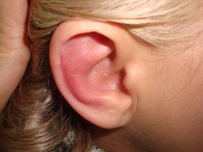 otituxakakichemlechitushnoyotitsimptomii A12624AE - Ушные капли при отите: какие лучше капли в уши при отите для детей и взрослых